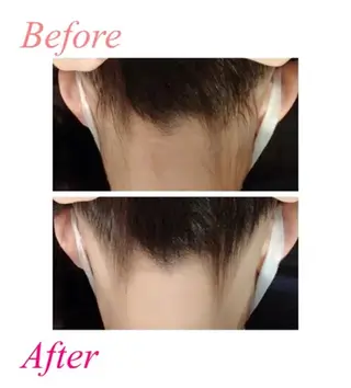 【医療提携】脱毛 小顔ハーブピーリングのエステ・リラクイメージ