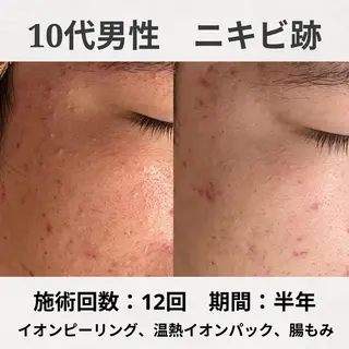 ニキビ特化型エステ 🍋最短で肌質改善のエステ・リラクイメージ