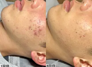 ピーリング×肌質管理 &meのエステ・リラクイメージ