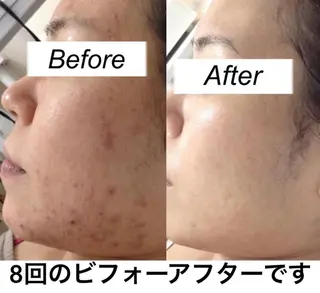 ミディアム カラー パーマ ヘアアレンジ キッズ ネイル マツエク・マツパ 都度払い肌質改善 &脱毛Blancheのエステ・リラクイメージ