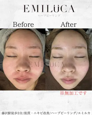 ハーブピーリング専門EMILUCA藤沢所属・ハーブピーリング /KAEDEのエステ・リラクイメージ