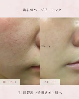 Purua beuty所属・ハーブピーリング RINAのエステ・リラクイメージ