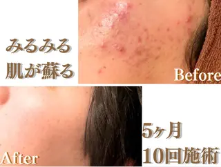 3か月で肌革命👼 ニキビ専門店💫のエステ・リラクイメージ