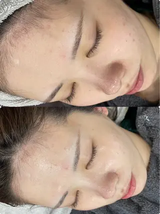 ニキビ／毛穴ケア ハーブピーリングのエステ・リラクイメージ