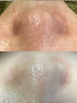 メンズ 韓国式３D毛穴洗浄＆ 脱毛vive京橋のエステ・リラクイメージ