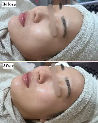 |ピーリング・毛穴| soina神楽坂のエステ・リラクイメージ