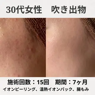 ニキビ跡改善専門🔥 医療にはできない改善のエステ・リラクイメージ