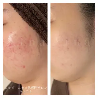 セミロング ヘアアレンジ メンズ マツエク・マツパ アイブロウ ニキビ跡専門サロン Ainaのエステ・リラクイメージ