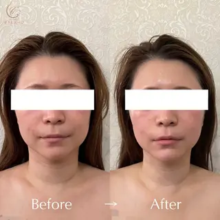 小顔/毛穴/肌質改善 💆セラピエージのエステ・リラクイメージ
