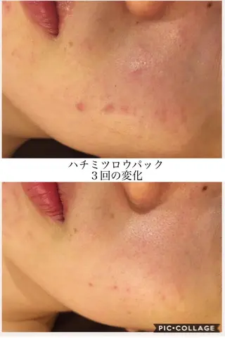 ニキビ・肌質改善専門 ♡人生が変わるサロンのエステ・リラクイメージ