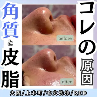 毛穴レス ハーブ& ワックス脱毛×光脱毛のエステ・リラクイメージ