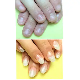 ネイル 深爪矯正/爪育成ケア manie nailのネイルデザイン