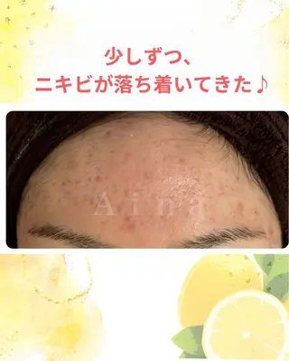 ニキビ跡専門サロン Ａｉｎａのエステ・リラクイメージ