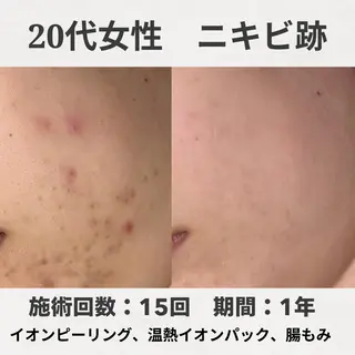 ニキビ跡改善専門🔥 医療にはできない改善のエステ・リラクイメージ
