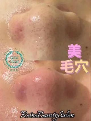 毛穴/シミ肝斑/脱毛 横山梨里のエステ・リラクイメージ