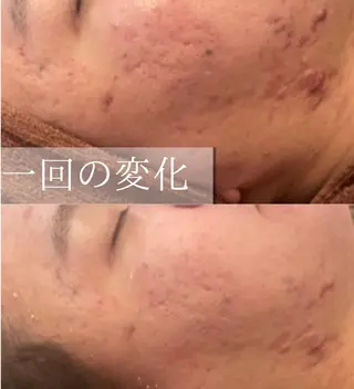 ロング カラー パーマ ヘアアレンジ メンズ キッズ ネイル マツエク・マツパ アイブロウ 3か月で肌革命👼 ニキビ専門店💫のエステ・リラクイメージ