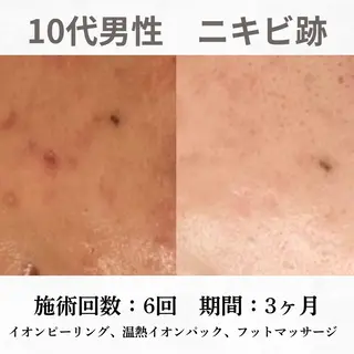 重度ニキビ専門🌷 ダウンタイムなしのエステ・リラクイメージ