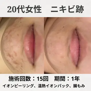 ニキビ跡改善専門🔥 医療にはできない改善のエステ・リラクイメージ