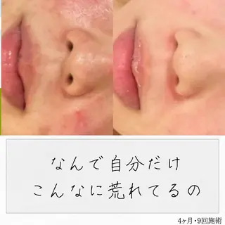 ニキビ経験者が施術 する専門サロン🌻のエステ・リラクイメージ