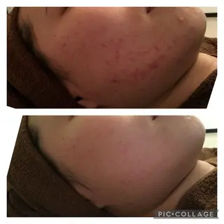 ニキビ/肌質改善専門 Snow skinのエステ・リラクイメージ