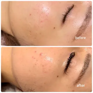 毛穴改善ハーブピーリングMinouミヌ心斎橋所属・今西 彩夢 Minou心斎橋店のエステ・リラクイメージ