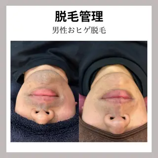 WAX・肌質改善・毛 穴洗浄/林愛真のエステ・リラクイメージ