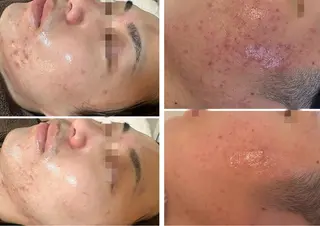 メンズ 小顔＆肌質改善 NICORIのエステ・リラクイメージ