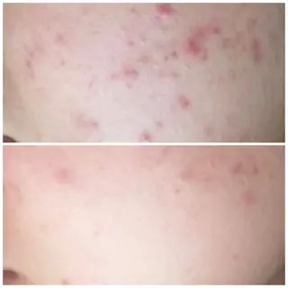 セミロング カラー パーマ ヘアアレンジ メンズ キッズ ネイル マツエク・マツパ アイブロウ 3か月で肌革命👼 ニキビ専門店💫のエステ・リラクイメージ