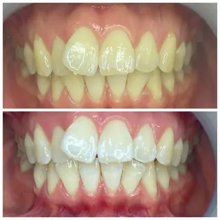 セルフホワイトニング 耳ツボジュエリーのエステ・リラクイメージ