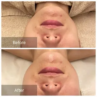 ハーブピーリング 肌再生ピーリング/のエステ・リラクイメージ