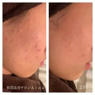 ミディアム カラー パーマ ヘアアレンジ メンズ キッズ ネイル マツエク・マツパ ニキビ跡専門サロン Ainaのエステ・リラクイメージ