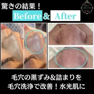 フローフシ∞💙 毛穴洗浄で毛穴レスのエステ・リラクイメージ