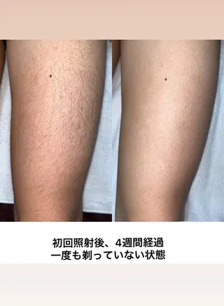 【本格脱毛】 グレイスフルルームのエステ・リラクイメージ