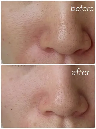 肌管理🌿毛穴改善 POLA堺東のエステ・リラクイメージ