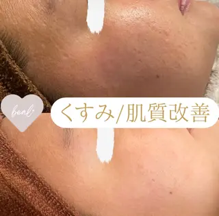小顔/毛穴/ニキビ salon bealのエステ・リラクイメージ