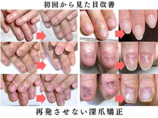 ネイル 深爪矯正・自爪育成 ネイルサロンアモここのネイルデザイン