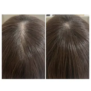 ニキビ 毛穴ケア シャルム ココ みさのエステ・リラクイメージ