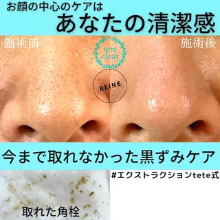 毛穴/シミ肝斑/脱毛 横山梨里のエステ・リラクイメージ