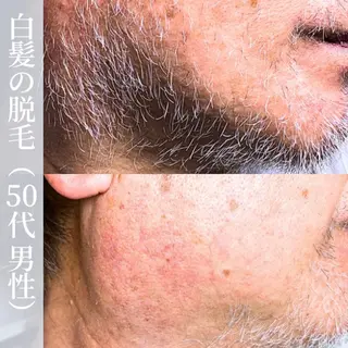 メンズ 【一本ずつ脱毛】 ReMove 柏のエステ・リラクイメージ