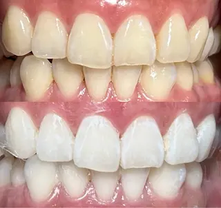 io teeth careのその他イメージ