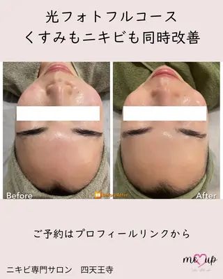 Meupニキビ専門店 背中/ハーブ/肌管理のその他イメージ