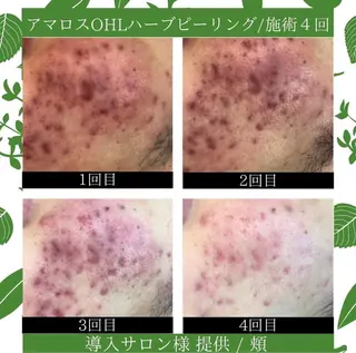 LiAm《美肌管理/ 小顔/脂肪ケア》のエステ・リラクイメージ