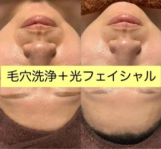 毛穴洗浄🍀脱毛🍀 光フェイシャル🍀のエステ・リラクイメージ
