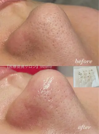 肌質改善Mbelle 越谷レイクタウン🌿のエステ・リラクイメージ