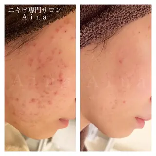 セミロング パーマ ヘアアレンジ メンズ キッズ ネイル マツエク・マツパ アイブロウ ニキビ跡専門サロン Ainaのエステ・リラクイメージ