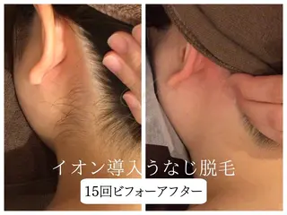 🎀うなじ脱毛🎀 ㅣLino堀江のエステ・リラクイメージ