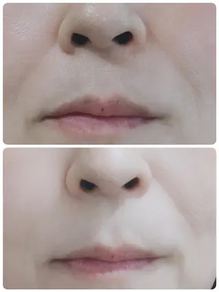 角質・毛穴洗浄🌼 脱毛🌸嶋津弘美のエステ・リラクイメージ