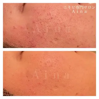 ミディアム カラー パーマ ヘアアレンジ メンズ キッズ ネイル マツエク・マツパ アイブロウ ニキビ跡専門サロン Ainaのエステ・リラクイメージ