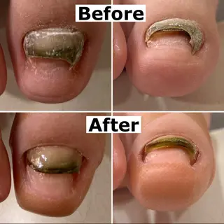 ネイル Mellow nail所属・巻爪無料モデル募集 ✨🦶MEGUMIのネイルデザイン