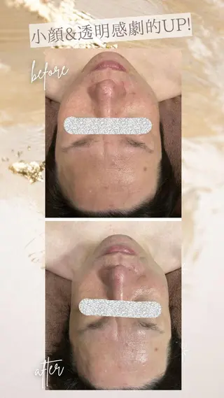 メンズ 頭蓋骨小顔矯正 ハーブピーリングのエステ・リラクイメージ